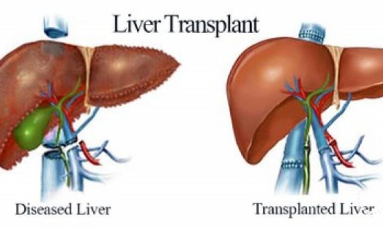 Unveiling Excellence: Top 13 Best Liver Transplantation Hospitals in India