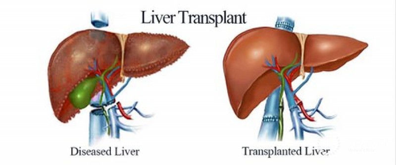 13 Best Liver Transplantation Hospitals in India